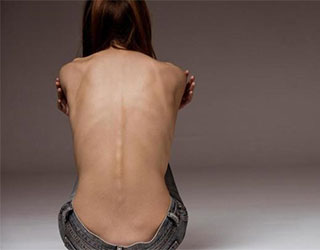 Motnje hranjenja: Tudi pretirana obsedenost z zdravo prehrano je motnja